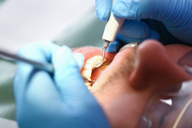 Best Knocked-Out Tooth (Avulsed Tooth) Treatment in Sparkill, NY
